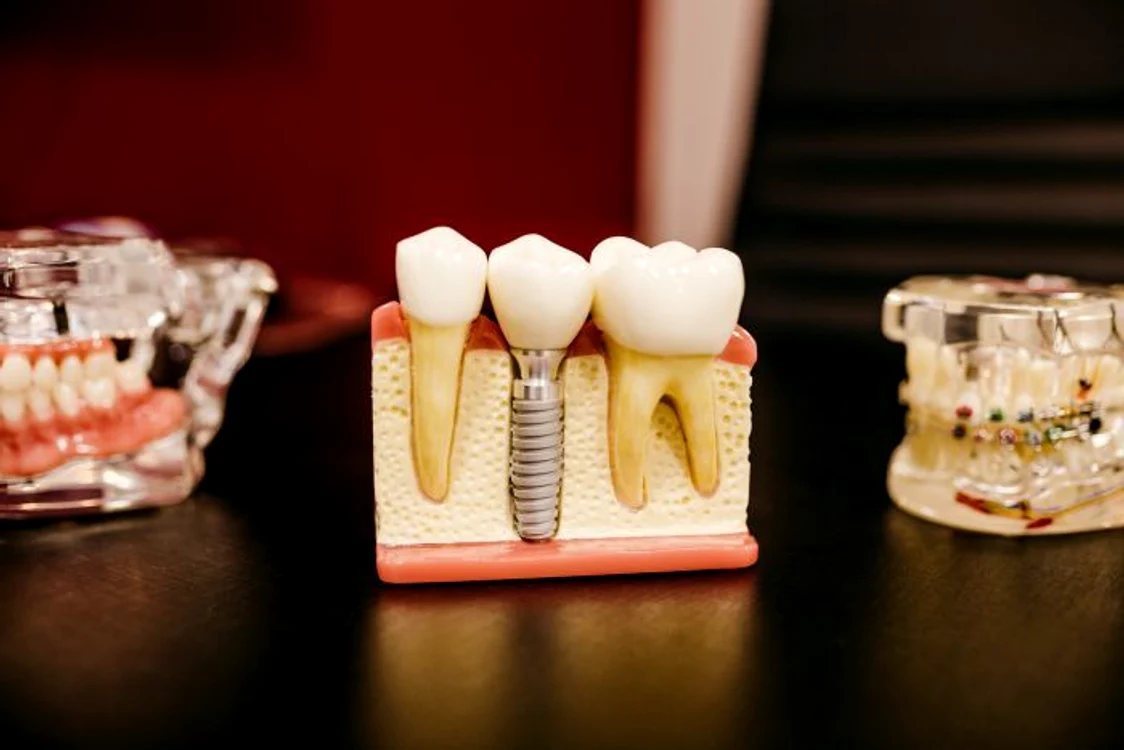 1 implant dentar cabinetstomatologicsector2 ro jpg jpeg