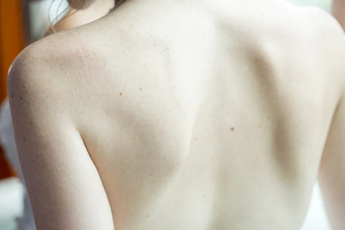 Primele semne ale cancerului de piele   FOTO Pexels