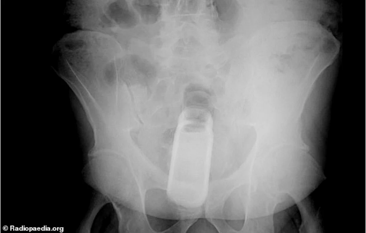 Tuburile de deodorant sunt printre cel mai des întâlnite obiecte „blocate“ în anus FOTO: Dailymail.co.uk