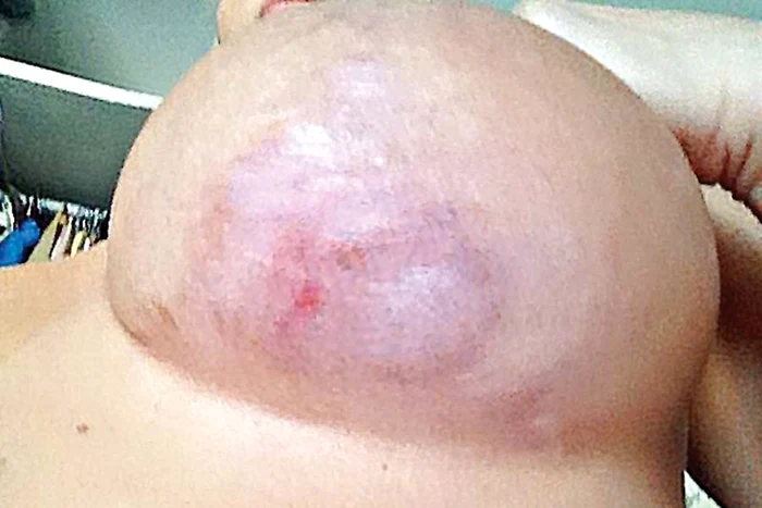 La cinci luni după  operaţie, Vica avea  sânii mai lăsaţi ca  înainte de intervenţie