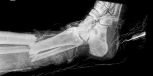 RADIOGRAFIE ŞOCANTĂ Uite cum arata piciorul fracturat al lui Wasilewski