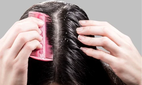 Scapă de mătreaţă rapid cu 10 remedii naturiste ieftine, dar eficiente! jpeg