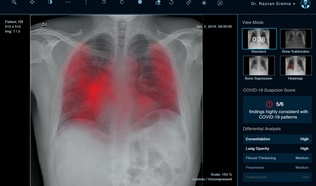 Startup-ul XVision identifică pacienții cu leziuni pulmonare asociate COVID-19
