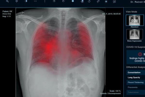 Startup-ul XVision identifică pacienții cu leziuni pulmonare asociate COVID-19