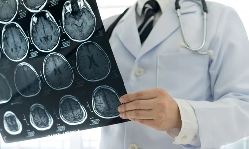 scleroza multipla jpg