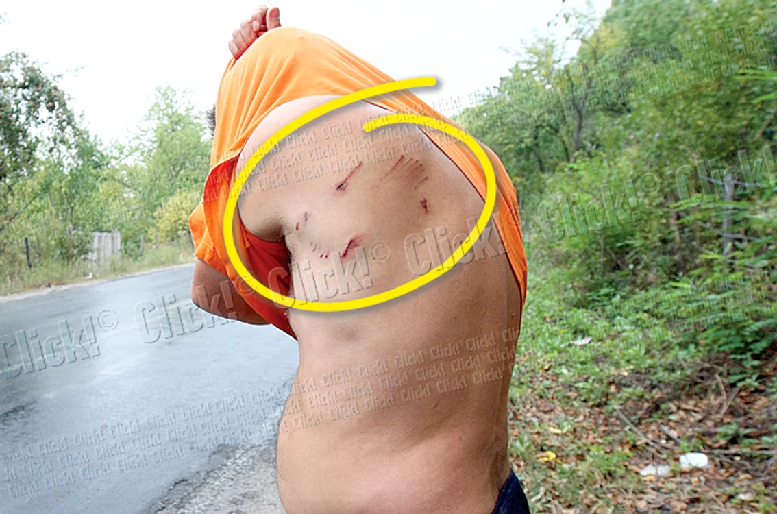 Bărbatul ne-a arătat  urmele lăsate de ghearele ursului pe corpul său (Fotografii: Dorin Constanda)