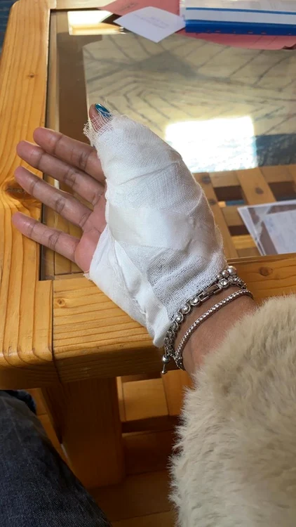 
    Așa arată genunchii lui Laurette după incidentul de la hotelfoto: arhivă personală  