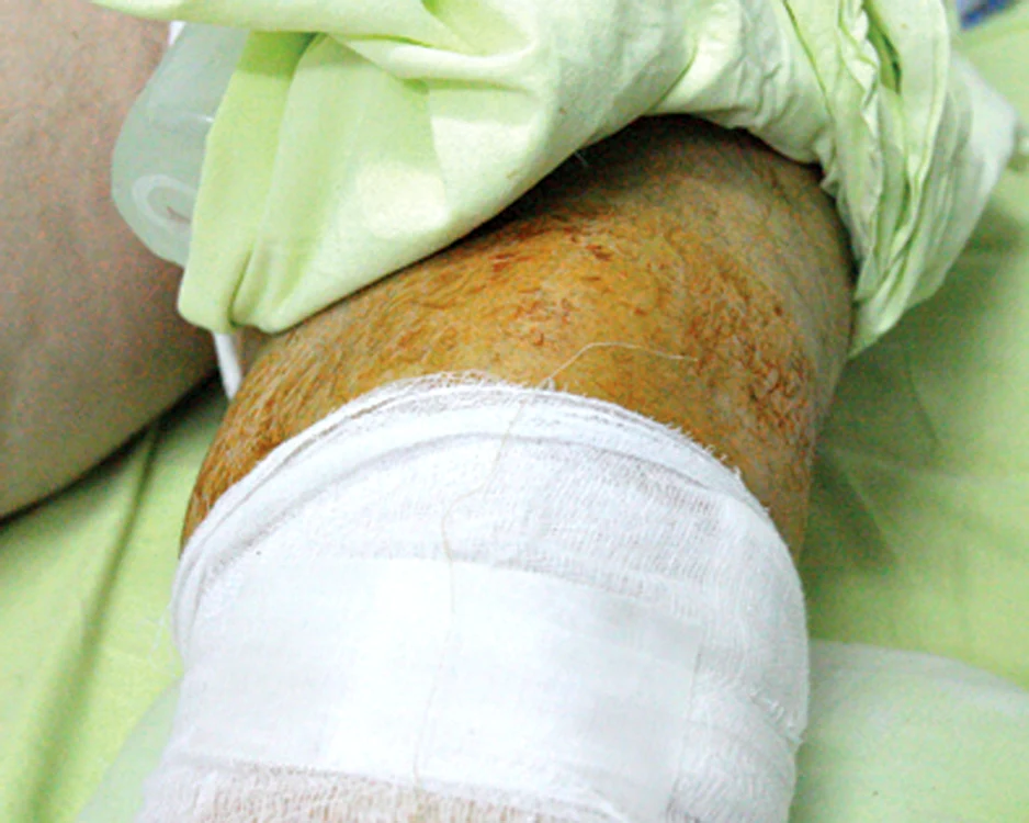 Degetul mare de la piciorul drept este rupt, iar genunchiul de la stângul a fost zdrobit. De aceea, medicii l-au operat de urgenţă şi i-au introdus tije.