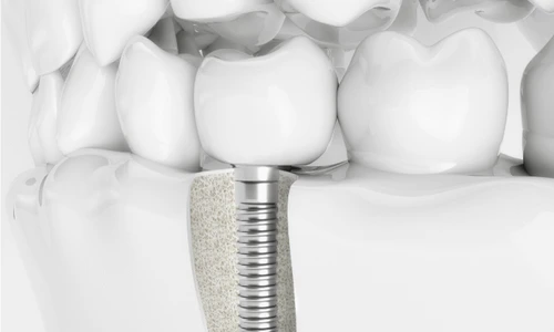 deceimplantuldentarartrebuisafieprimaoptiunedeinlocuireaunuidintepierdut1 png