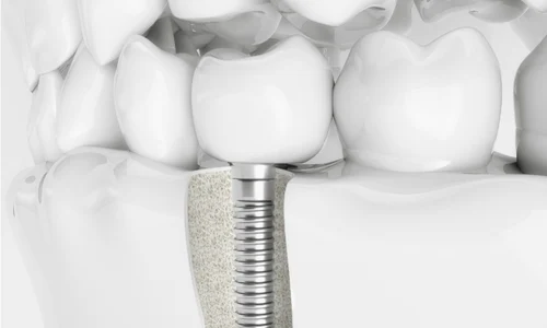 deceimplantuldentarartrebuisafieprimaoptiunedeinlocuireaunuidintepierdut1 png