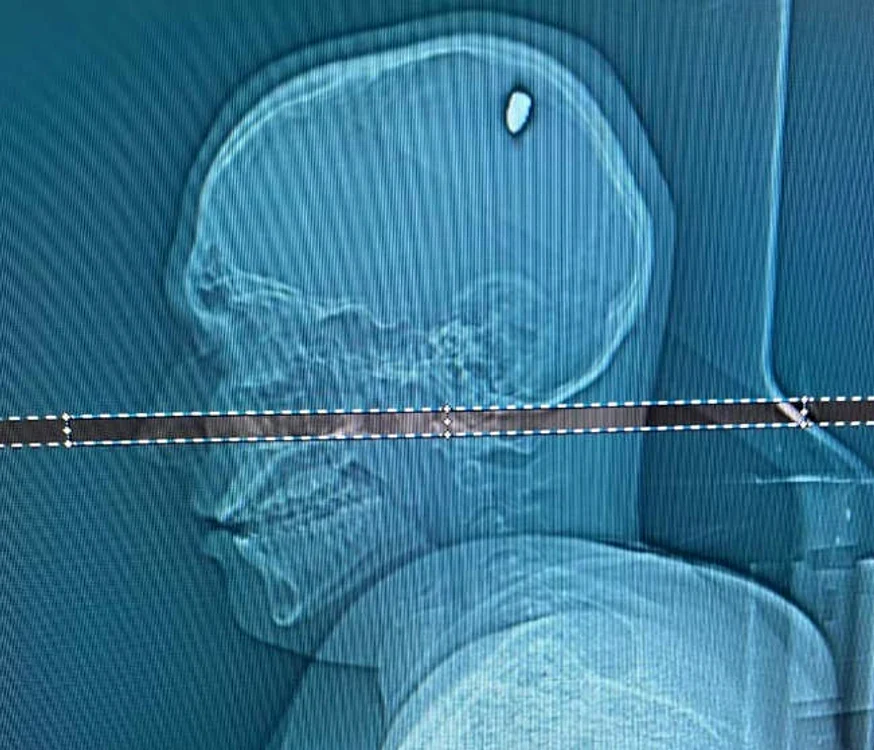 Doctorii au descoperit că avea un glonț de 9 mm în craniu (foto: captură video)