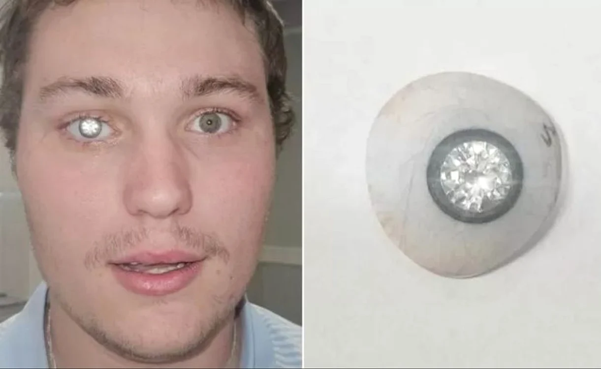 Slater Jones și-a pus o proteză oculară strălucitoare (Foto: Capturi video)