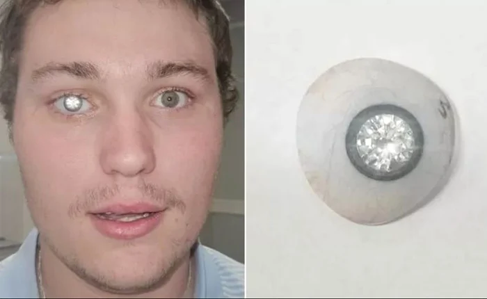 Slater Jones și-a pus o proteză oculară strălucitoare (Foto: Capturi video)