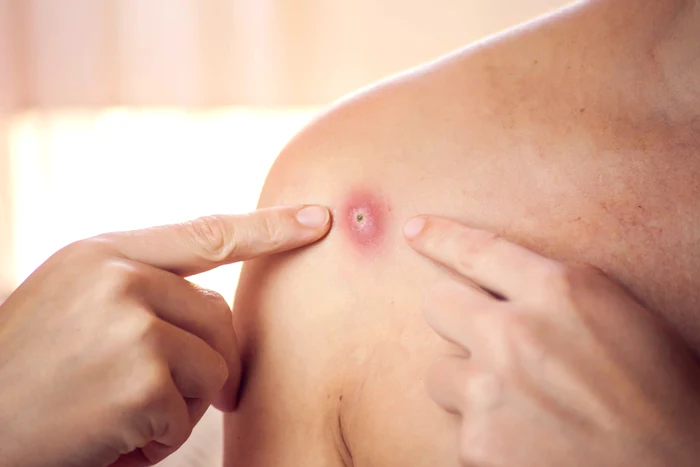 Unguentul, făcut în casă, care te ajută să scapi de hemoroizi, furuncule, răni și arsuri.