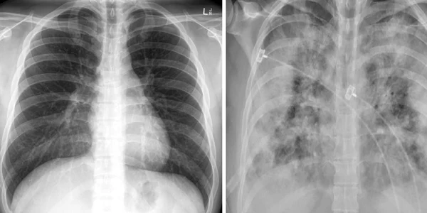 plamani radiografie COVID
