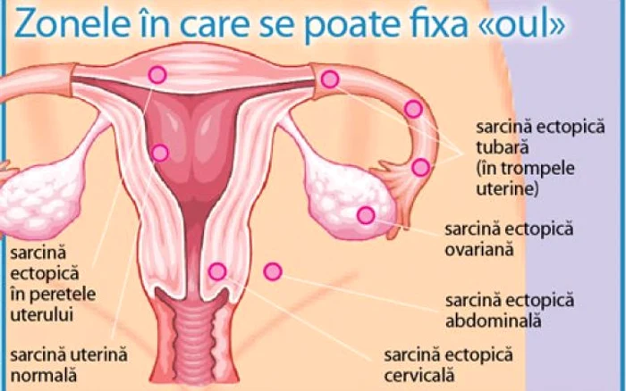 Sarcina extrauterina