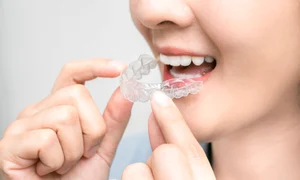 1 aparat dentar transparent jpg jpeg