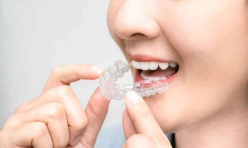 1 aparat dentar transparent jpg jpeg