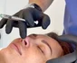 Nicoleta Luciu a recurs la o rinoplastie non-chirurgicală la medicul Iancu Morad foto: arhiva personală