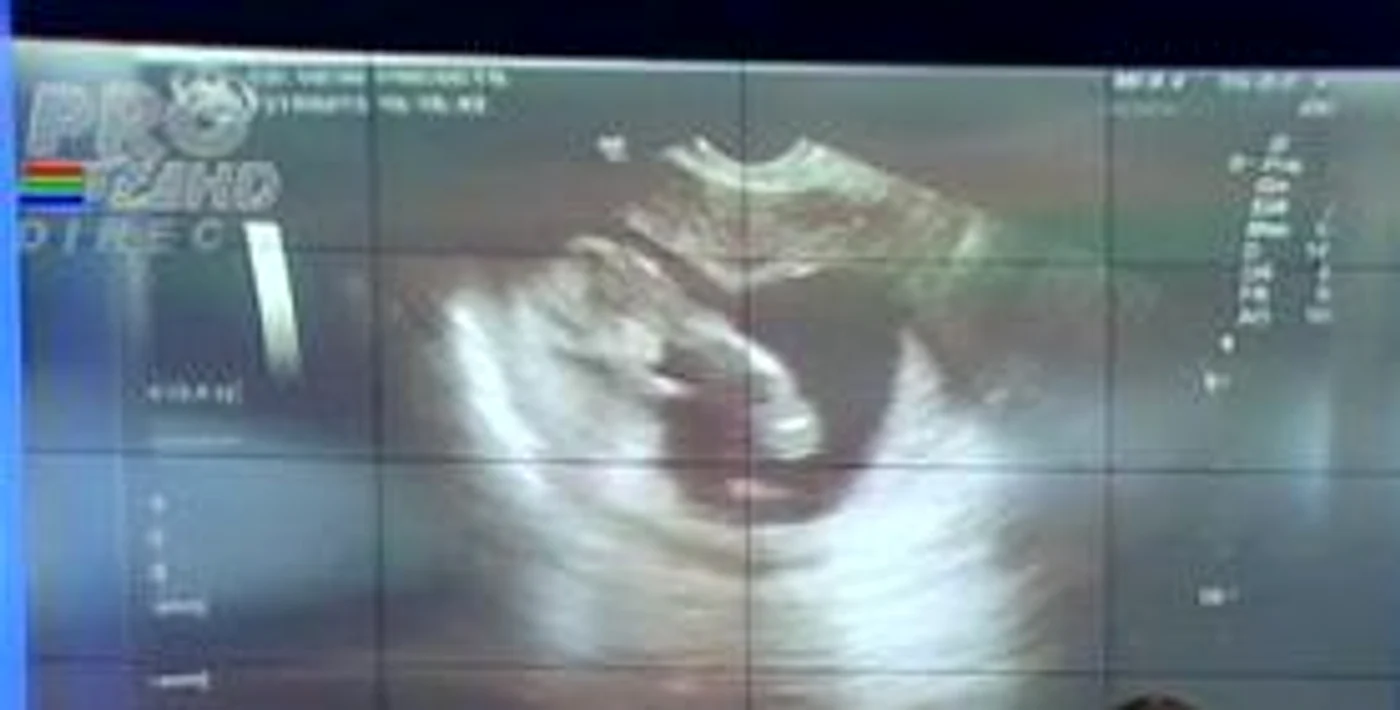 Aceasta este prima ecografie a copilului Oanei Roman (captură: PRO TV)
