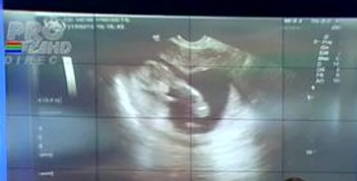 Aceasta este prima ecografie a copilului Oanei Roman (captură: PRO TV)