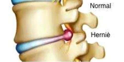 hernie de disc