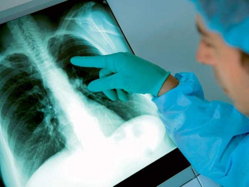 Tuberculoza este din nou pe primul loc în top-ul deceselor cauzate de bolile infecțioase. Pneumolog: „Ne-am așteptat să urmeze o creștere”