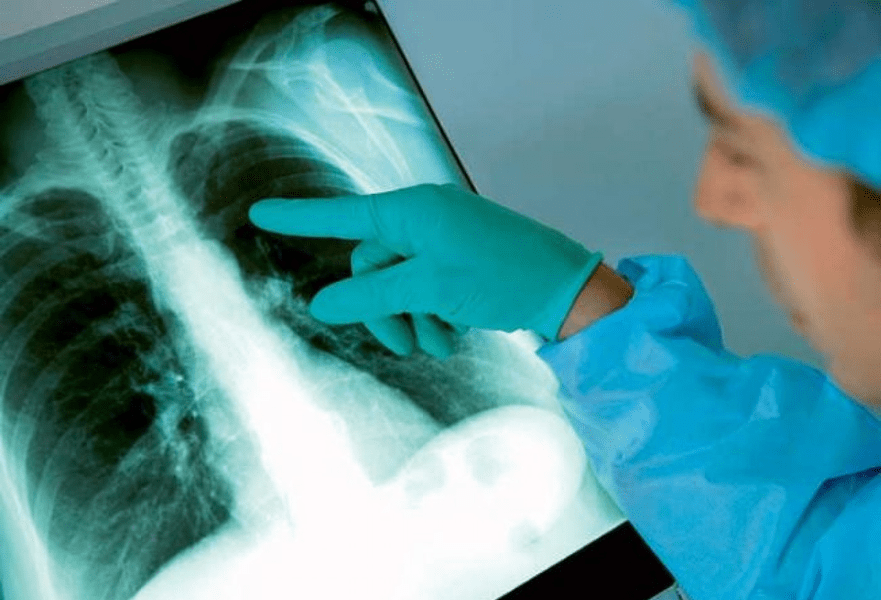Semnal de alarmă privind răspândirea tuberculozei. Specialiștii avertizează că avem un regres major în controlul bolii