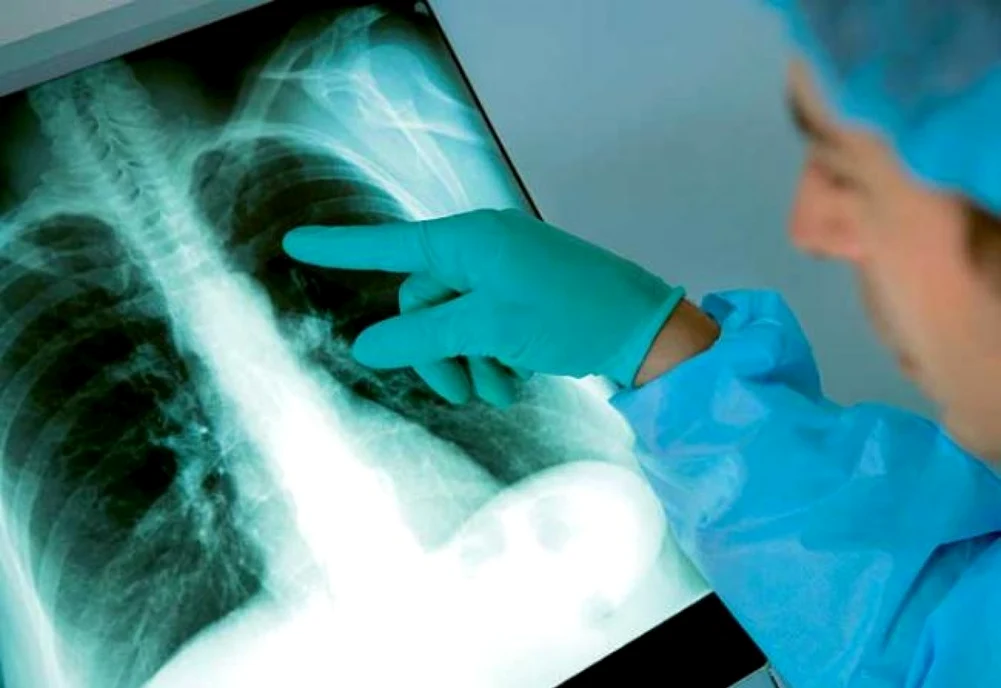 Numărul de cazuri de tuberculoză, pe cale să explodeze FOTO Ministerul Sănătății