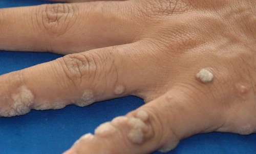 negii tratament si metode de prevenire a aparitiei lor jpeg