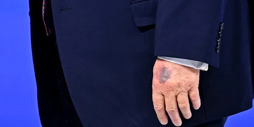 Donald Trump la Davos vânătaie pe mână FOTO AFP 20260122 jpg