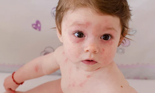 1 copil rubeola jpg jpeg