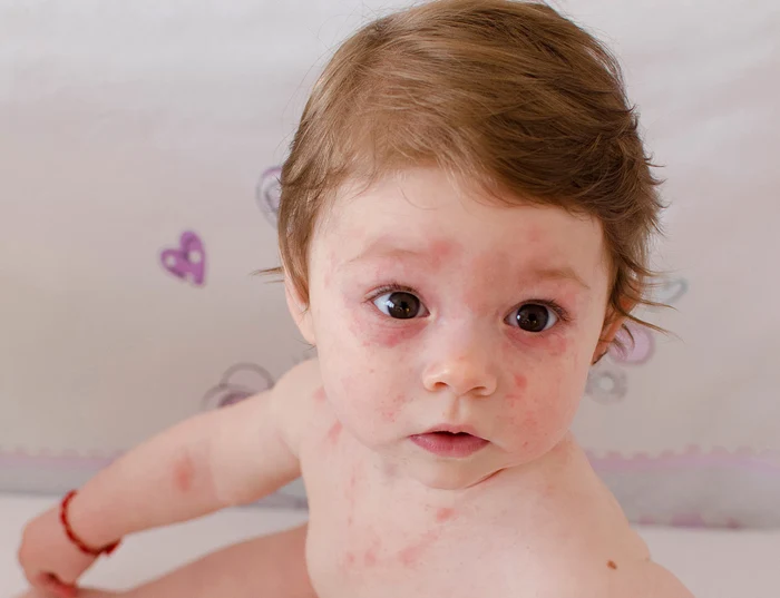 1 copil rubeola jpg jpeg