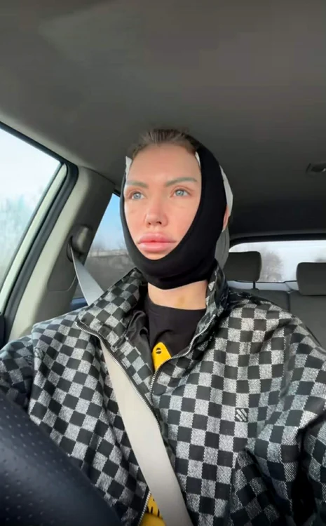 Oana și-a făcut o nouă intervenție estetică - Foto: social media