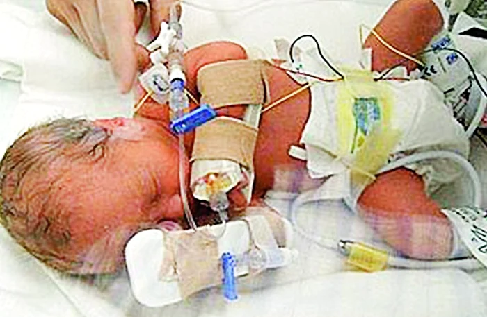 
    Operaţia a fost extrem de dificilă, doctorii introducând  un dispozitiv microscopic cu care au pulverizat lipici  