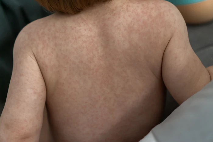 Cele mai frecvente cauze ale exantemului viral în copilărie