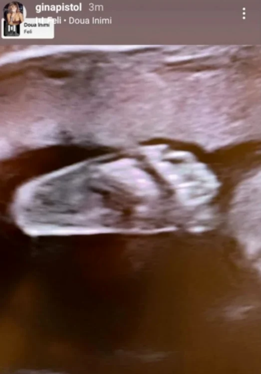 Ecografia bebelușului