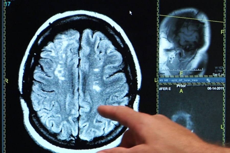 Pacientă cu AVC, plimbată între spitale pentru că la Ploiești nu a fost găsit un neurolog. Femeia a rămas cu sechele