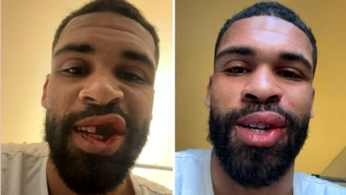 Ruben Loftus-Cheek, înainte și după operație FOTO AC Milan