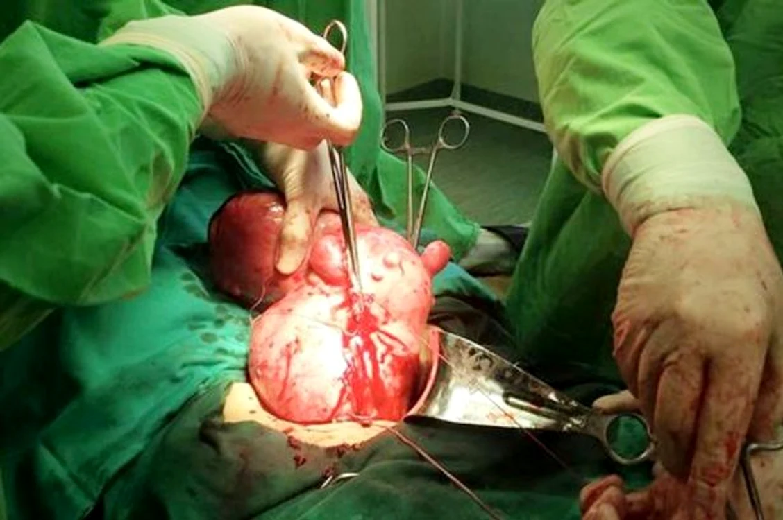 Medicii au descoperit că femeia avea o tumoare în uter şi au operat-o de urgenţă