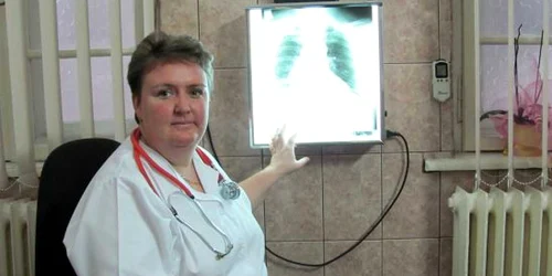 Dr. Mihaela Marţus cu radiografia unui fumător pasionat