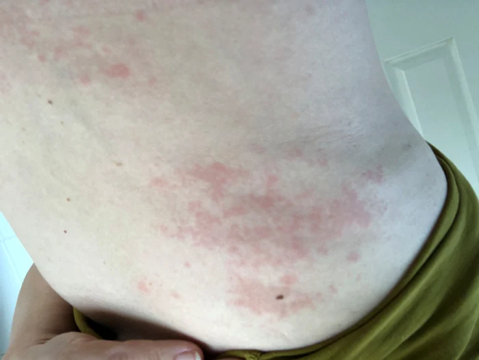 Petele roșii pe abdomen, printre noile simptome ale infecției cu Covid-19