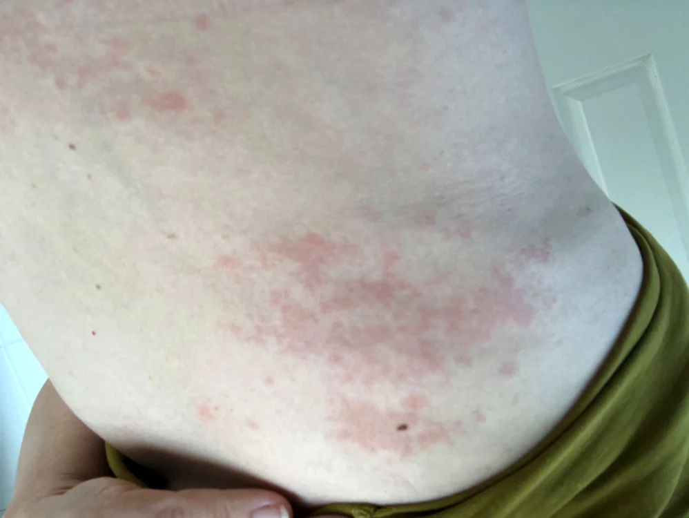 Petele roșii pe abdomen, printre noile simptome ale infecției cu Covid-19