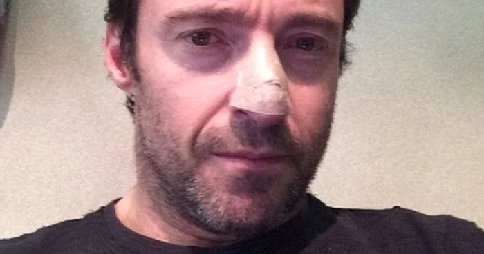 Jackman (45 de ani) atrage atenţia asupra cancerului de piele. FOTO Instagram/ Reuters