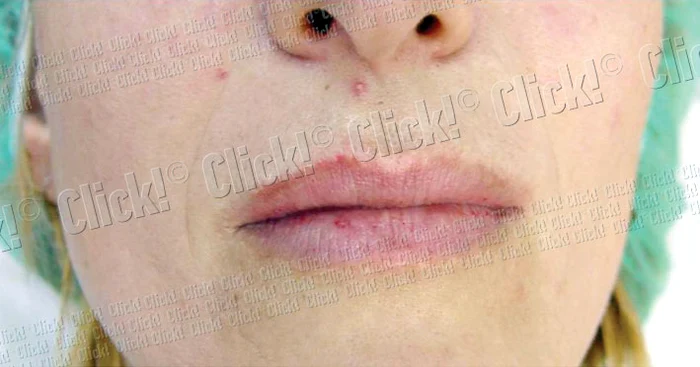 Şi-a mărit buzele  cu injecţii