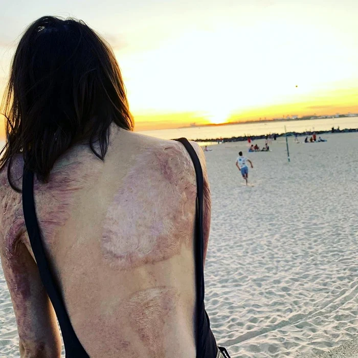 
    Alexandra Furnea a revăzut marea după patru ani. În acest timp a fost operată de zeci de ori după incendiul din Clubul ColectivFOTO: Facebook  