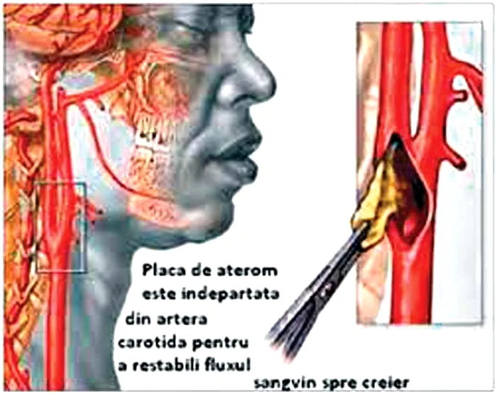 Placa de aterom  (grăsimea) este  îndepărtată din  artera carotidă  pentru a restabili fluxul sangvin