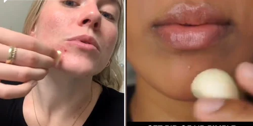 Aplicarea usturoiului crud pe față o tendință la modă pe rețelele de socializare Colaj TikTok