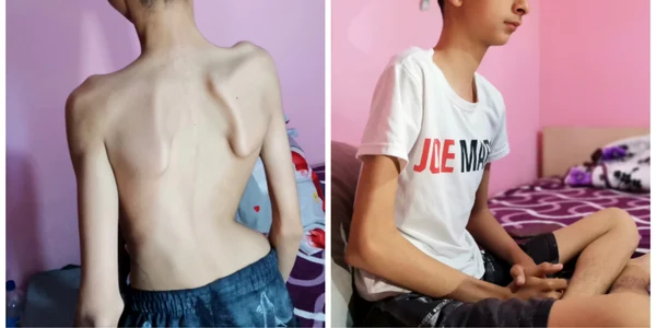 caz umanitar bogdan calota adolescent scolioza neuroomusculara   foto alina mitran (7) jpg