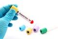 factor reumatoid jpg